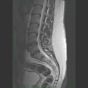 Herniated Disc - May 2022