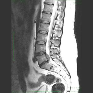 Herniated Disc - January 2022