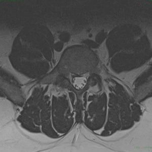 Herniated Disc - After