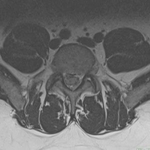 Herniated Disc - Before