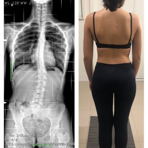 Scoliosis 13th - April 2021