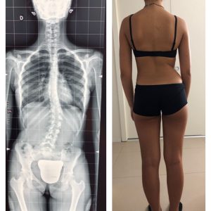 Scoliosis of 27th - July 2020